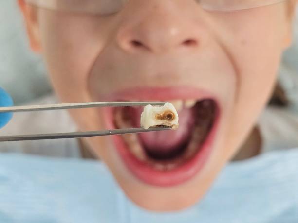 Best Emergency Dentist for Lost Fillings or Crowns in Rosedale, MS